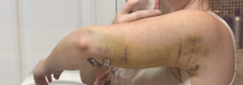 Read my personal experience with double brachioplasty surgery, including before and after photos, recovery insights, and reflections on body confidence after significant weight loss.