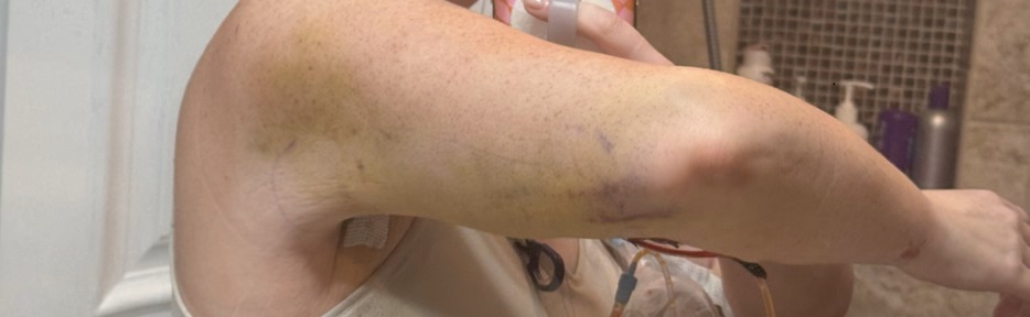 Read my personal experience with double brachioplasty surgery, including before and after photos, recovery insights, and reflections on body confidence after significant weight loss.