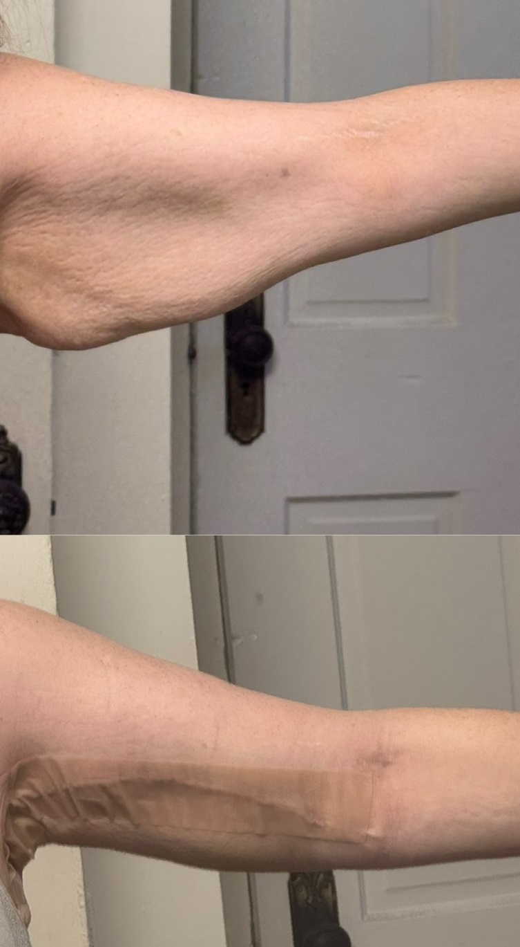 Read my personal experience with double brachioplasty surgery, including before and after photos, recovery insights, and reflections on body confidence after significant weight loss.